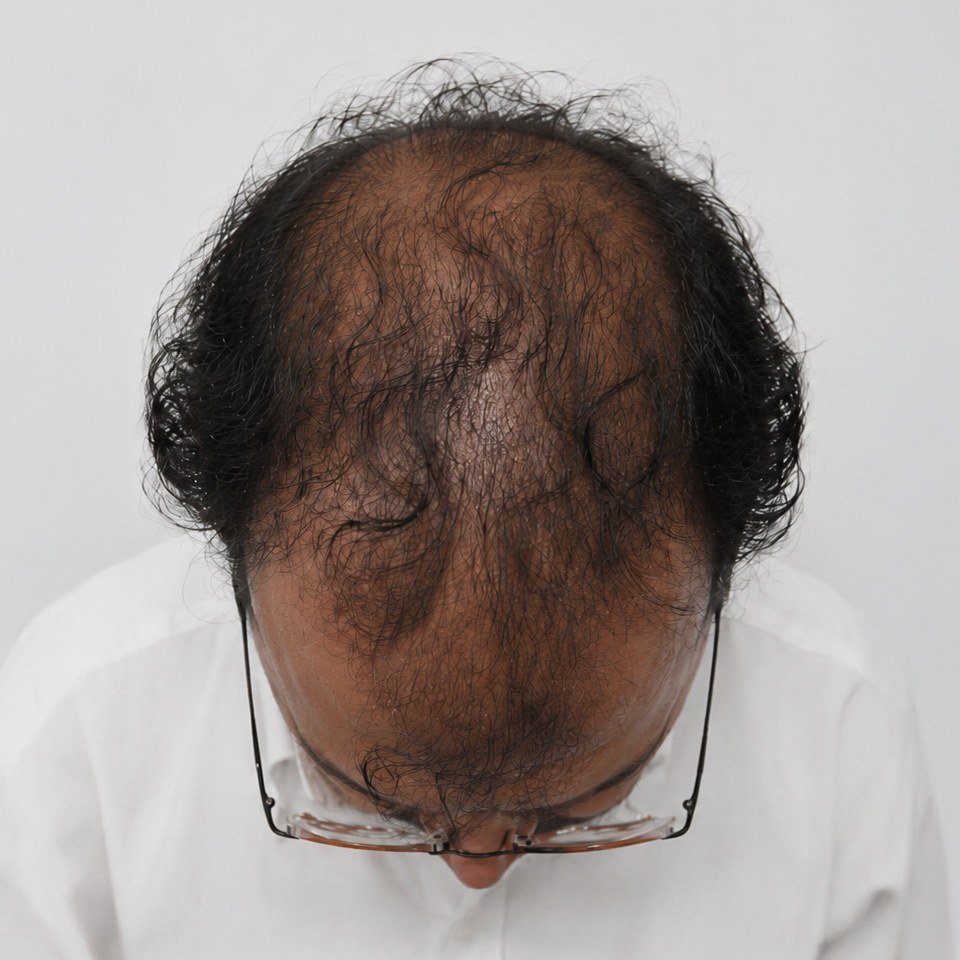 Baseline Scalp Thinning Before Treatment